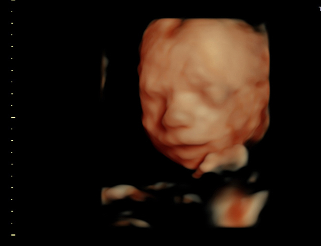 3D ultrasound image at 25 weeks